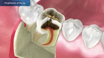 Close-up cross section of a molar tooth showing severe decay progression inside the enamel and pulp.