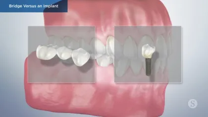 Comparison of dental bridge and dental implant on upper teeth gums.