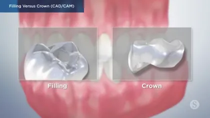 Comparison of dental filling and crown showing differences in coverage on a tooth model.