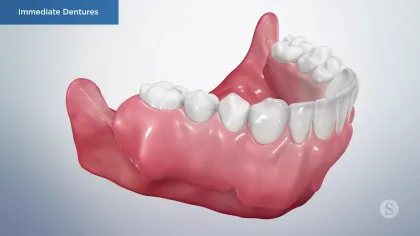 3D illustration of immediate dentures showing pink gums and white teeth for dental restoration.