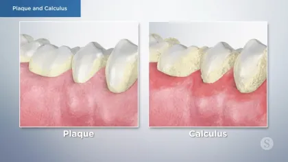 Close-up illustration of teeth and gums showing plaque buildup and hardened calculus deposits.