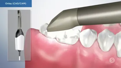 Digital dental onlay design using CAD/CAM technology showing tooth preparation and scanning process.