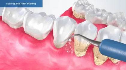 Dental procedure scaling and root planing removing plaque and tartar from teeth below the gumline.