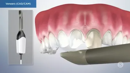 Digital CAD/CAM tool scanning teeth for creating dental veneers with a close-up of upper teeth and gums.