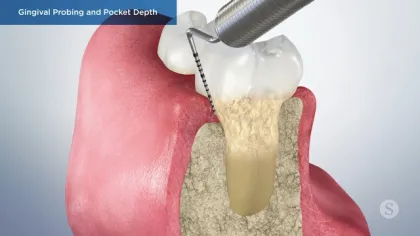 Dental probe measuring gingival pocket depth around a tooth to assess gum health and periodontal status.