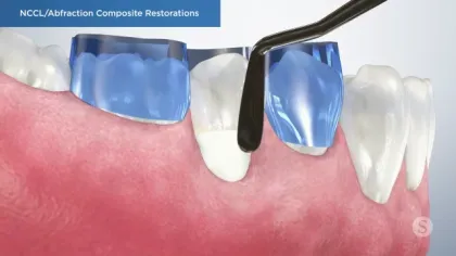 Dental composite restorations applied to abfractions on lower teeth using blue matrix bands and dental tool.