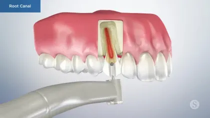 3D illustration of a root canal procedure showing dental tool cleaning the tooth root inside gums.