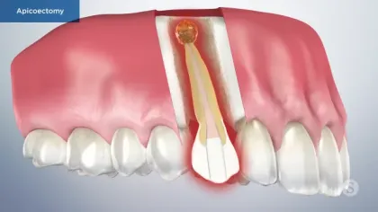 3D illustration of a tooth undergoing apicoectomy showing root tip removal and inflamed tissue.