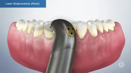 Dental laser device performing gingivectomy on upper gums for periodontal treatment.