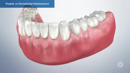 3D illustration of lower human teeth and gums showing dental prophy and periodontal maintenance comparison