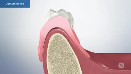 Cross-section of jawbone showing pink denture reline material fitting snugly under dentures on gums.