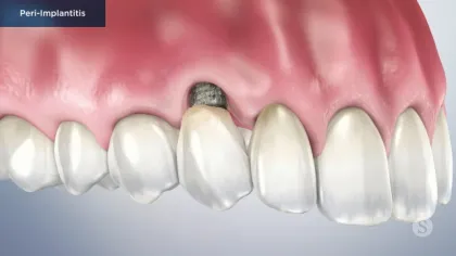 Close-up of upper teeth showing peri-implantitis with exposed implant and inflamed gums.