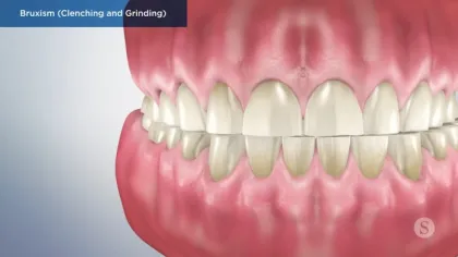 Close-up of teeth and gums illustrating bruxism with clenching and grinding of teeth
