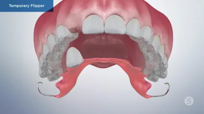 3D illustration of a temporary flipper dental appliance replacing a missing upper front tooth.