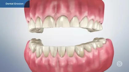 3D illustration of dental erosion showing worn teeth with damaged enamel on upper and lower jaws