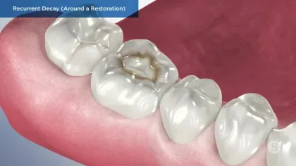 Close-up of molar teeth showing recurrent decay around a dental filling restoration on a pink gum background