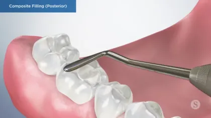 Dental composite filling being applied to a posterior molar tooth with a dental instrument inside the mouth.