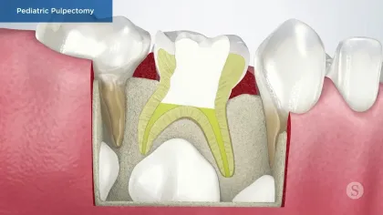 Illustration of pediatric pulpectomy procedure showing treated tooth with pulp removed in child's jawbone.