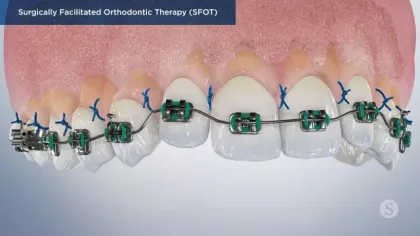 Close-up of teeth with green orthodontic braces and blue surgical sutures for SFOT treatment.