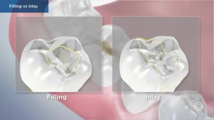 Comparison of dental filling and inlay restorations on a molar tooth showing material placement.