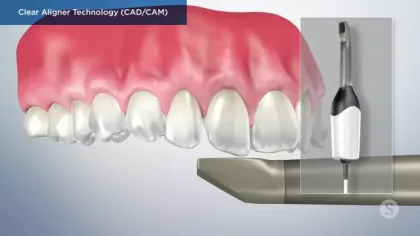 Digital Clear Aligner Technology (CAD/CAM) showing dental scanning and aligner design process over teeth.