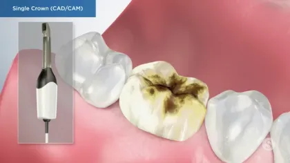Dental CAD/CAM tool preparing a single crown for a decayed molar tooth with surrounding healthy teeth.