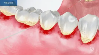 Close-up illustration of teeth with plaque buildup and inflamed gums showing gingivitis symptoms.
