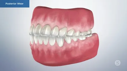 3D dental model showing posterior wear with worn down back teeth and gum tissue in a side view.