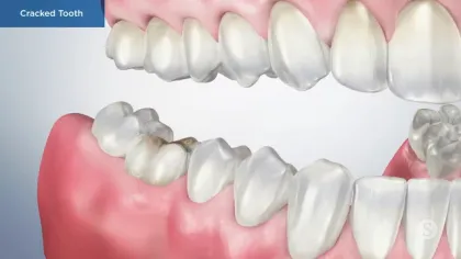 3D dental illustration showing cracked tooth among healthy teeth with gums visible.
