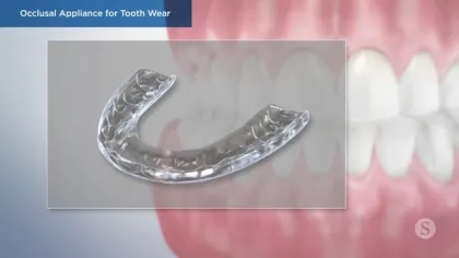 Clear occlusal appliance for tooth wear displayed against a blurred dental background.