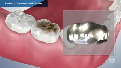Illustration of pediatric dental crowns showing healthy, decayed, and stainless-steel crown on molars inside gums.