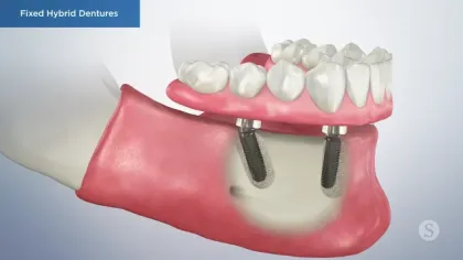 3D illustration of fixed hybrid dentures mounted on two dental implants in lower jawbone section.