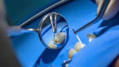 Close-up of dental tools and a mirror inspecting a tooth on a blue surgical drape during dental treatment.