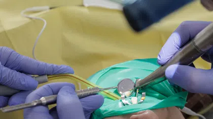 Close-up of dental procedure using rubber dam and dental tools with gloved hands visible