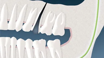 3D illustration of a cracked tooth in a dental X-ray style side view of jaw and teeth.
