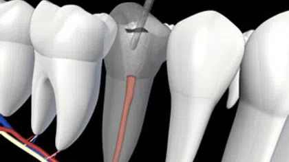 3D illustration of a root canal treatment procedure on a molar tooth showing nerves and tools.