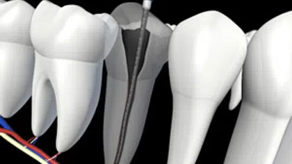 3D illustration of root canal treatment showing dental file cleaning inside a tooth root canal.