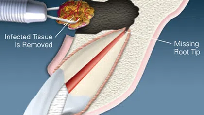 Dental illustration showing removal of infected tissue from missing root tip during endodontic surgery.