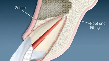 Cross-section of a tooth showing root-end filling and suture in dental surgical procedure.
