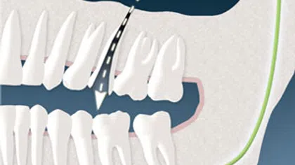 Illustration of a dental root canal treatment showing a file cleaning inside a tooth root canal of a molar.