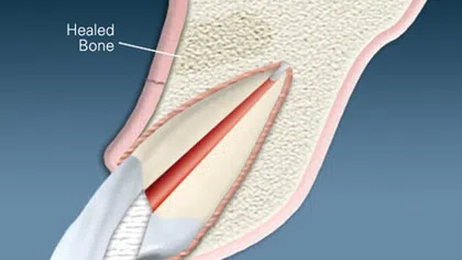 Cross-section of a healed bone surrounding the root of a tooth within the jawbone shown with labeled healed bone area.