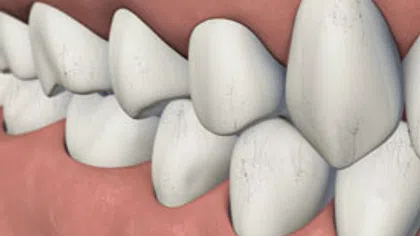 Close-up of human teeth showing dental crowding with overlapping and misaligned teeth in gums.