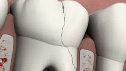 Close-up of a cracked tooth showing the fracture line extending through the enamel.
