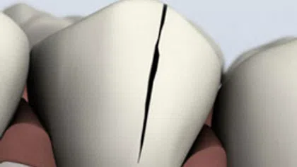 Close-up of a tooth with a visible vertical crack between healthy adjacent teeth and gums.