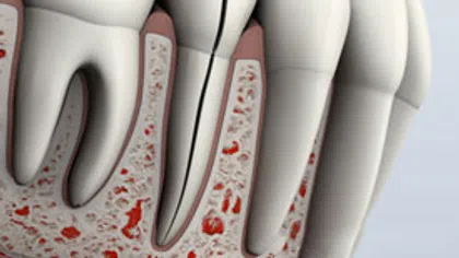 Cross-section of human teeth and gums showing a cracked tooth with underlying bone and tissues.