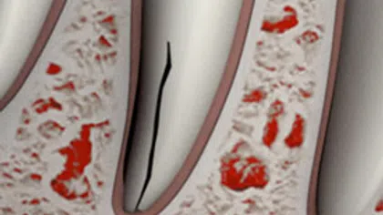 Close-up of a cracked tooth root within jawbone showing dental fracture details in red and beige tones.