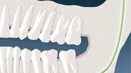 Illustration of human teeth focusing on the lower jaw and wisdom teeth in the skull.
