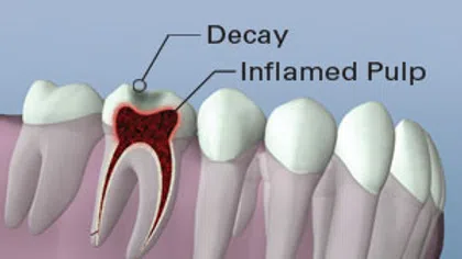 Cross-section of a tooth showing decay and inflamed pulp labeled inside the tooth near healthy teeth.