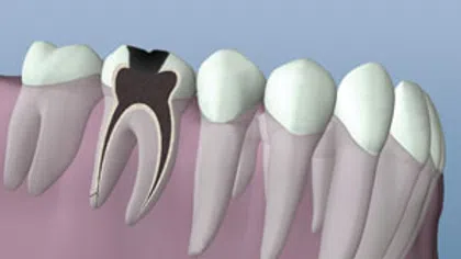 Cross-section of molar tooth showing cavity decay and surrounding healthy teeth and gums.