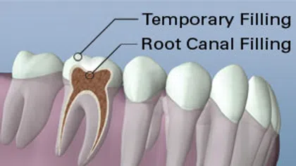 Cross-section of a tooth showing temporary filling and root canal filling inside the tooth structure.